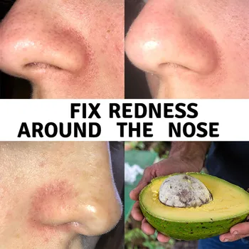 Эссенции для увлажняющего крема для лица от покраснения вокруг носа Авокадо Противовоспалительное Средство, Успокаивающее кожу Гиалуронат натрия Увлажняющий